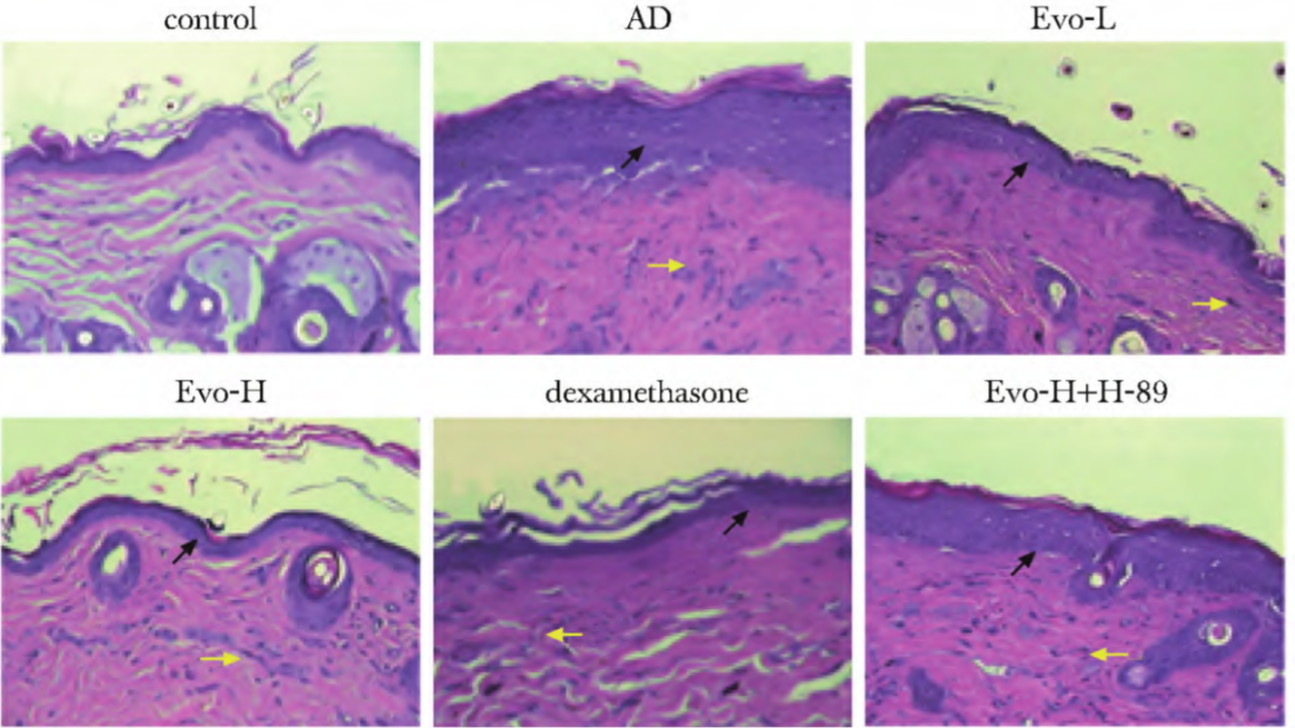 图1 AD: atopic dermatitis; The black arrows indicate thickening of the epidermis and the yellow arrows indicate infiltration of inflammatory cells; *P<0.05 compared with control; #P<0.05 compareed with AD; ▵P<0.05 compared with Evo-I (5mg/kg); ▴P<0.05 compared with Evo-H(10mg/kg) <sup>[2]</sup>.